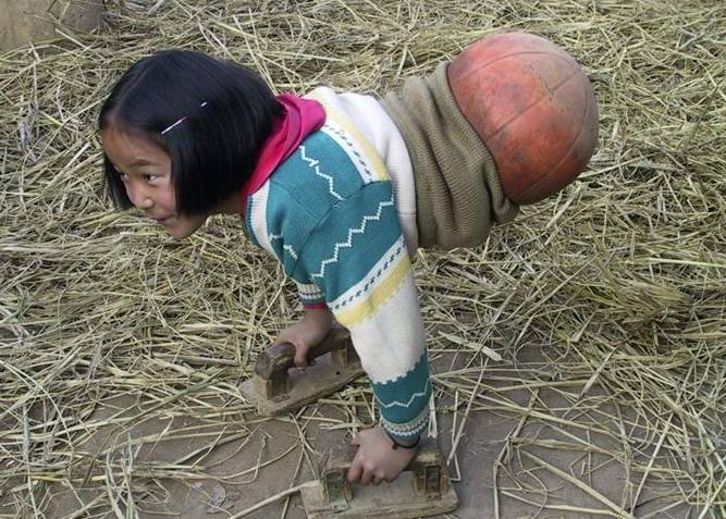 Qian Hongyan, "Basketball Girl": la bambina con una palla al posto delle gambe è una nuotatrice professionista