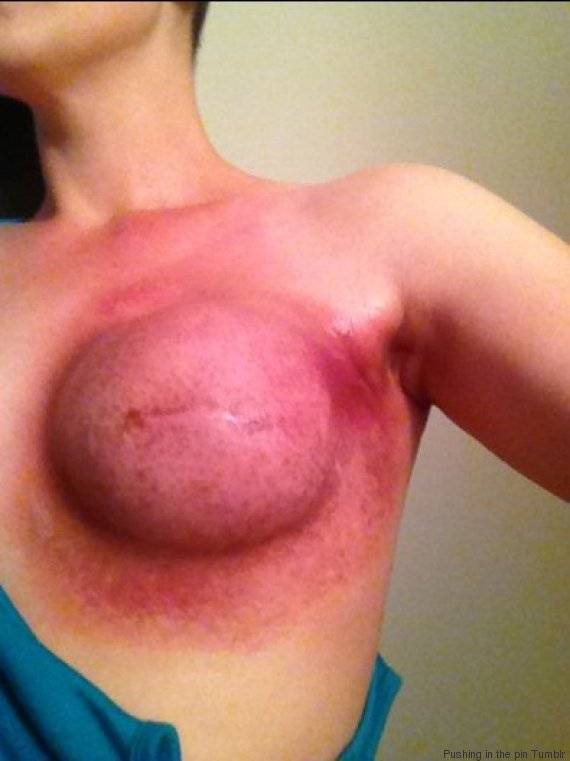 "Il cancro non è sexy", donna pubblica la foto del seno dopo la chemio