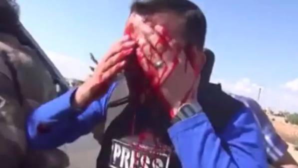 Reporter colpito da una scheggia in diretta tv