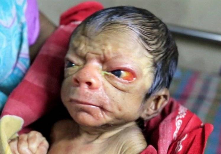 Neonato dimostra 80 anni a causa della progeria, una rara malattia 