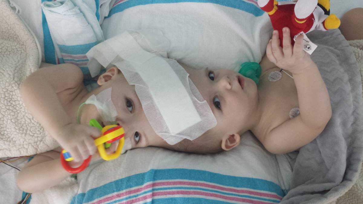 Usa, due gemelli siamesi separati dopo 27 ore di intervento