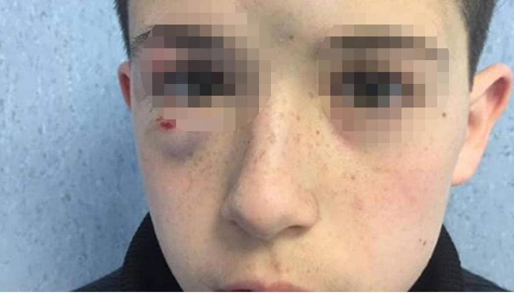 Napoli, genitori postano su Fb le foto choc del figlio 13enne aggredito dai bulli
