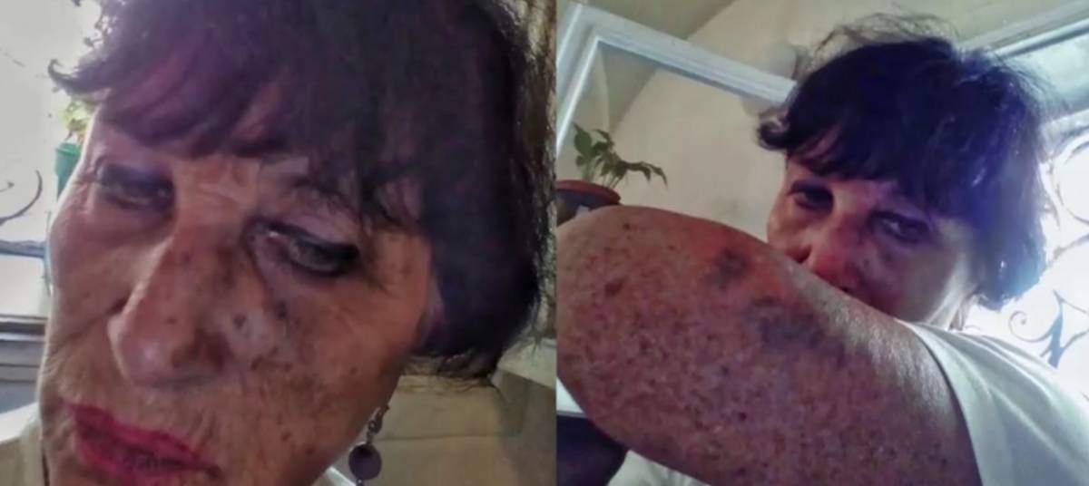 L'anziana massacrata in metro dalla rom: ​"Ero una maschera di sangue"