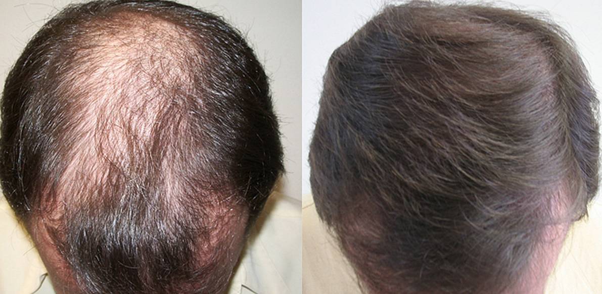 Alopecia, ecco il farmaco che fa recuperare tutti i capelli