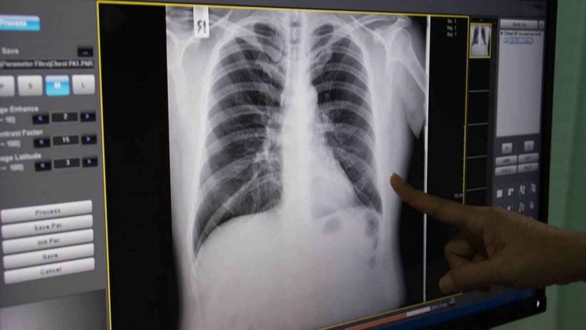 Bimbo di 5 anni contagiato da tubercolosi ricoverato in ospedale