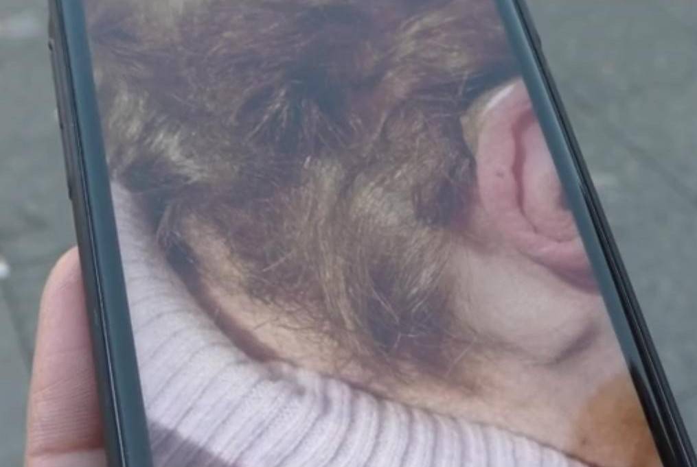Napoli, 83enne accoltellata durante rapina: la lama ancora nel collo