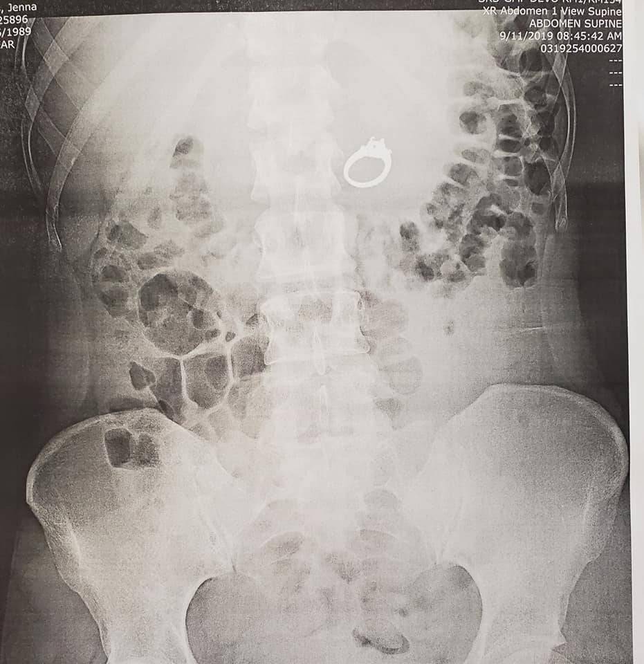 Sogna di ingoiare l'anello: finisce in pronto soccorso