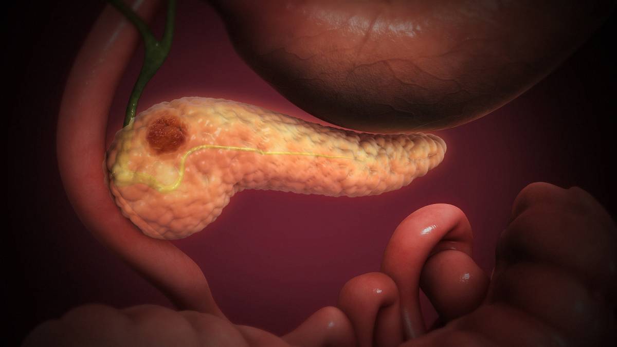 Tumore al pancreas, ecco quali sono i sintomi