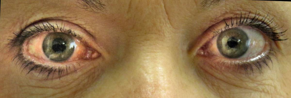 Glaucoma, la malattia subdola che distrugge la vista