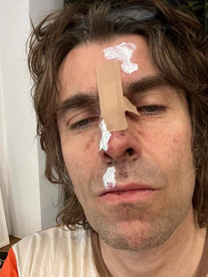 Liam Gallagher e il volto tumefatto: cos'è successo