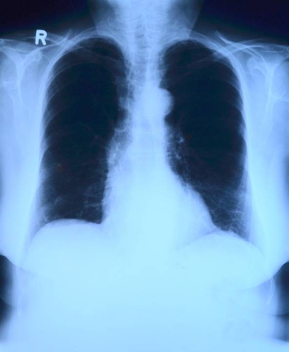 Legionella: cos'è la malattia che colpisce i polmoni