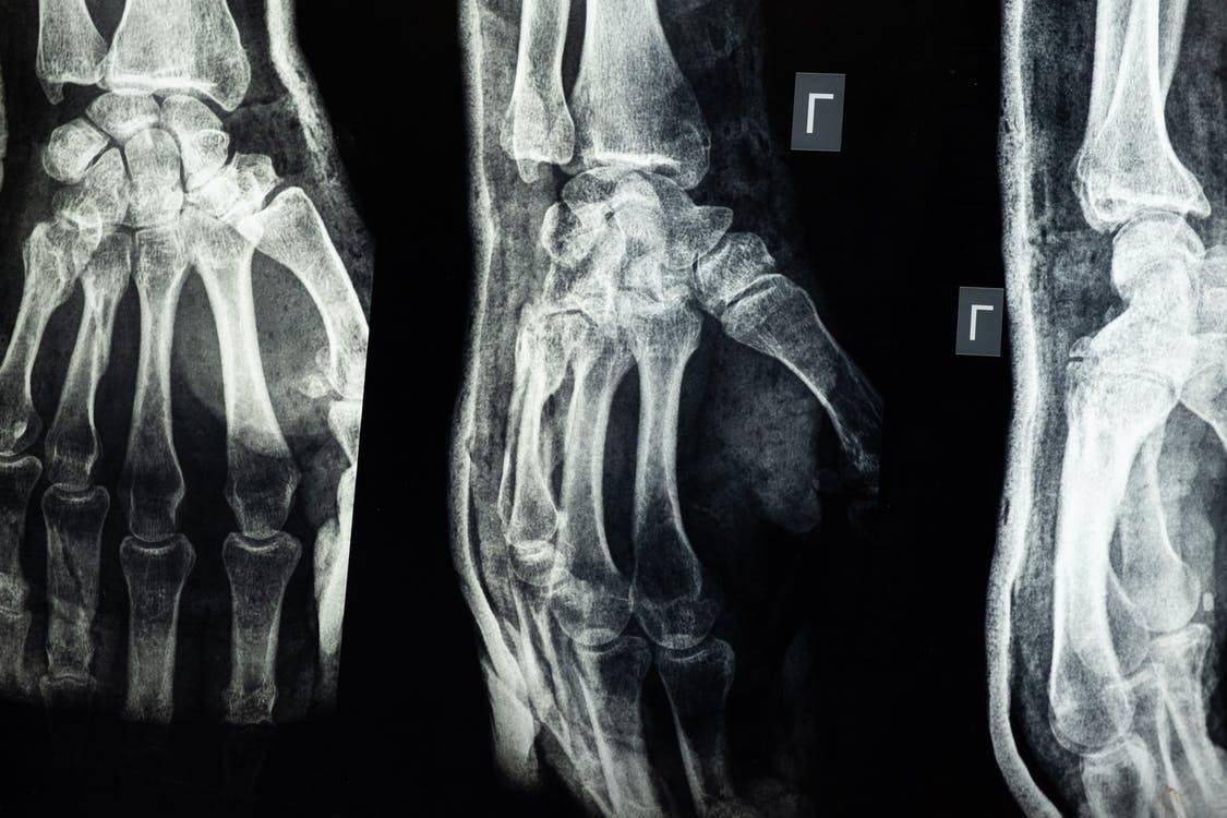 Protesi ortopediche, un tatuaggio elettronico ne monitora la salute