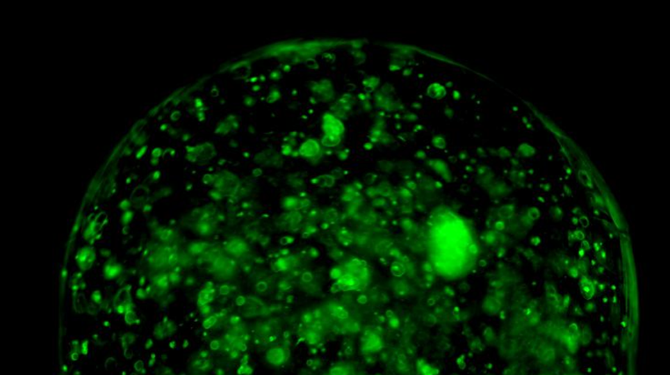 Campione tridimensionale di tumore al pancreas illuminato tramite luce laser verde. Si può notare uno spot luminoso di intensità estrema (tsunami ottico) che permette il trasporto di energia attraverso l’intricata struttura di cellule tumorali.