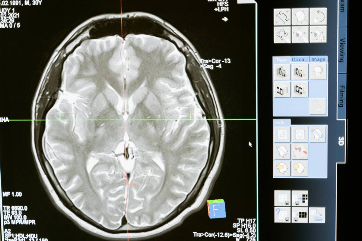 Schizofrenia, individuati nuovi geni coinvolti: in arrivo farmaci più mirati per la cura