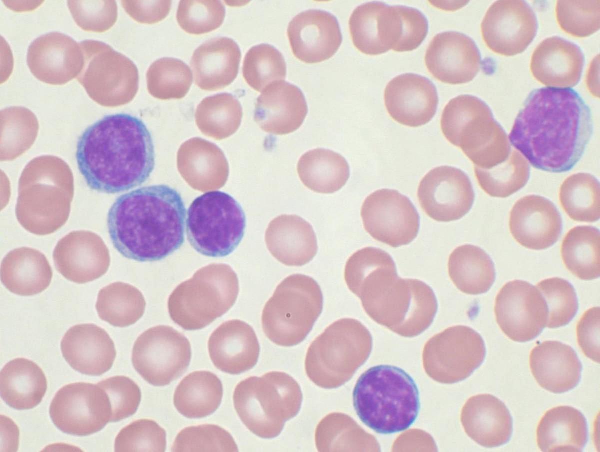 Leucemia linfatica cronica, nuove speranze dalla ricerca: le terapie per contrastare la patologia