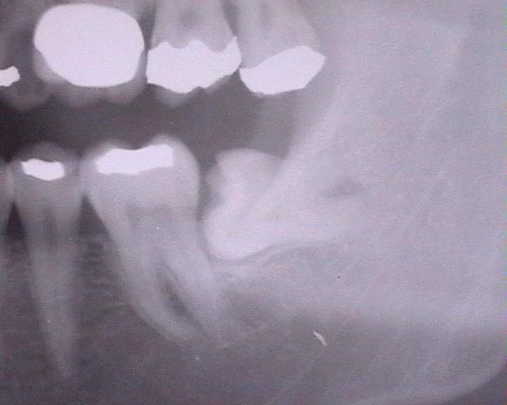 Denti del giudizio, non sempre è necessario rimuoverli. Ecco quando è necessario