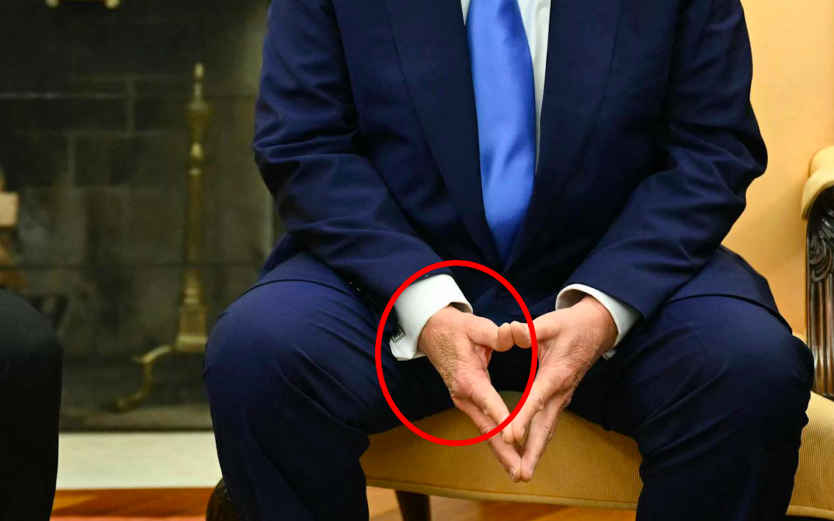 Cosa ha fatto Trump alla mano? Mistero sui social, ma spunta la verità sul livido