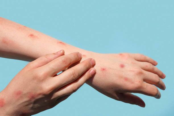 Come alleviare una puntura d'insetto?