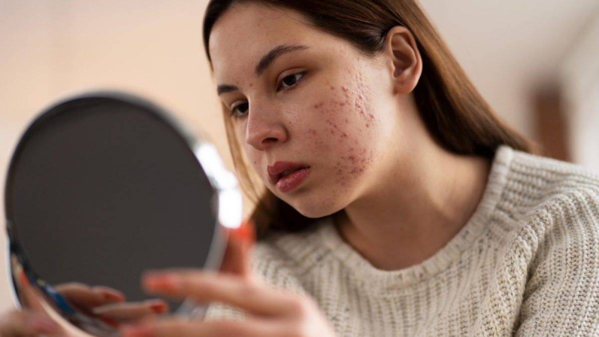 Nuovo trattamento innovativo contro l'acne in arrivo in Europa