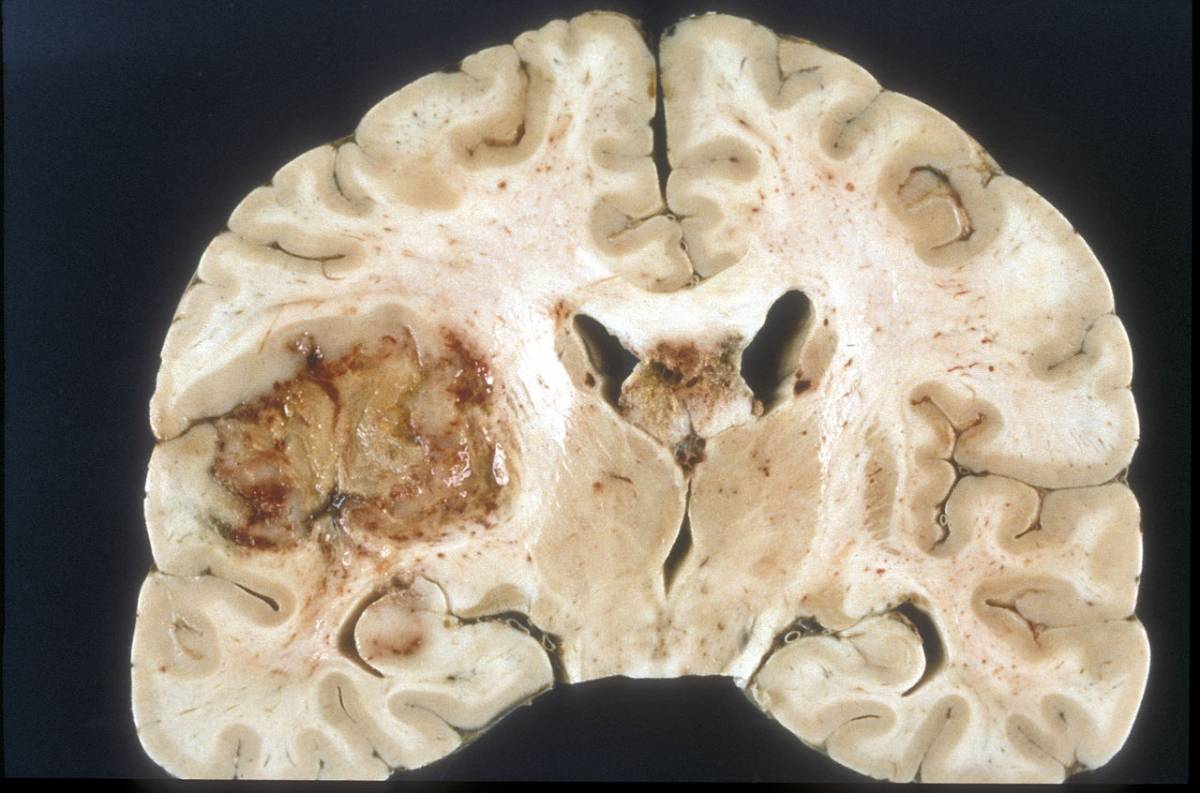 Glioblastoma, nuove speranze per la forma più grave di tumore al cervello