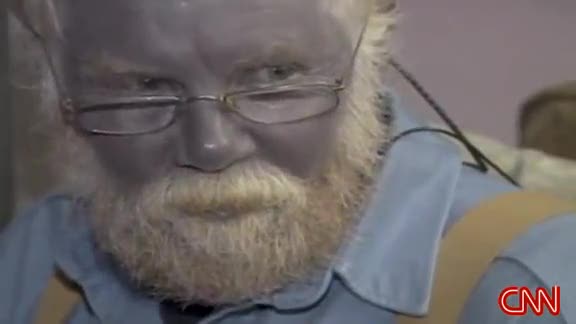Paul Karason, l'uomo blu, è morto