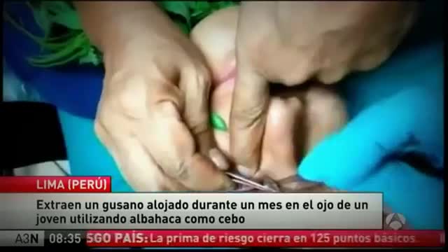 Così è stato rimosso il verme dall'occhio